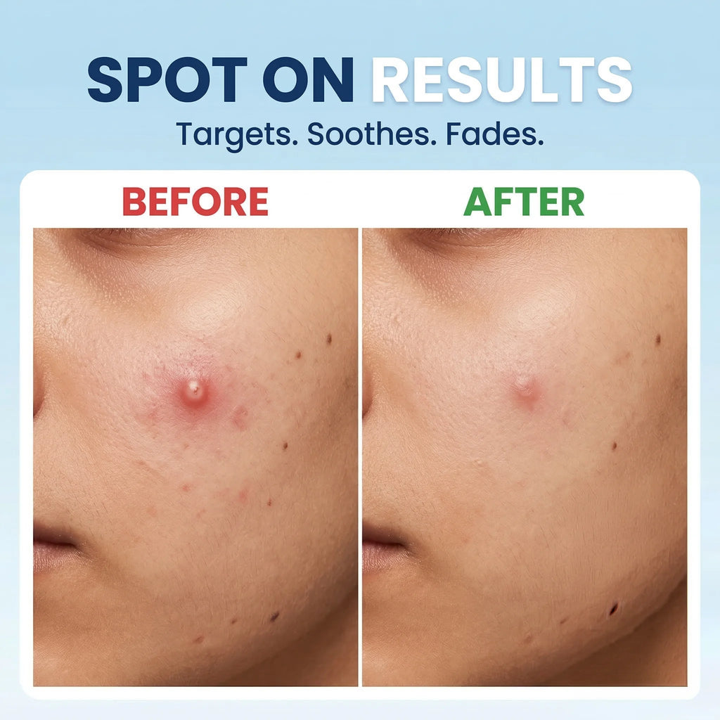 Acne Eraser Gel | Fade Pimples