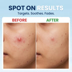 Acne Eraser Gel | Fade Pimples